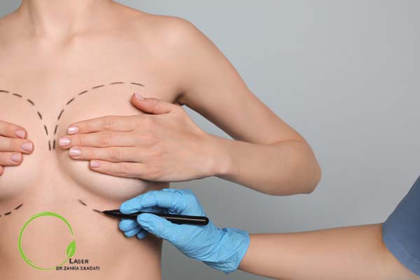 انواع برش جراحی در پروتز سینه