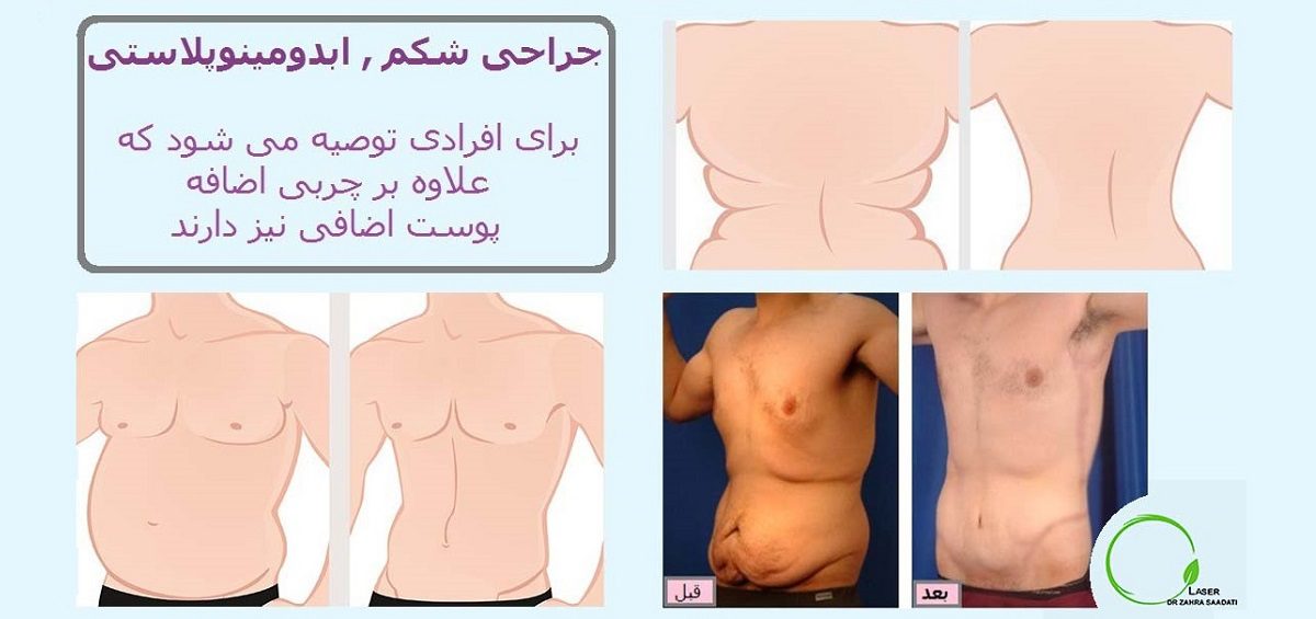 قبل و بعد جراحی زیبایی شکم دکتر سعادتی تامی تاک ابدومینوپلاستی