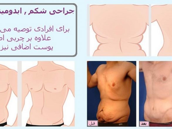 قبل و بعد جراحی زیبایی شکم دکتر سعادتی تامی تاک ابدومینوپلاستی
