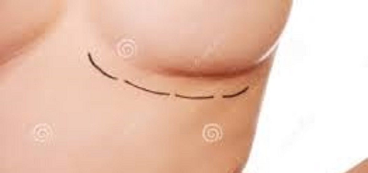 جراحی سینه به منظور کاهش سایز افزایش سایز سینه و یا لیفت و پروتزسینه انجام می شود