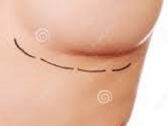 جراحی سینه به منظور کاهش سایز افزایش سایز سینه و یا لیفت و پروتزسینه انجام می شود