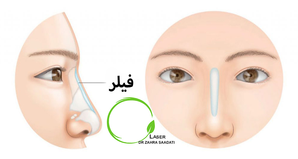 تزریق ژل به بینی به منظور اصلاح فرم