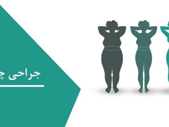 جراحی چاقی نوعی جراحی زیبایی برای افرادی که کاهش وزن شدید داشته اند