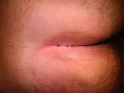 درمان و جراحی کیست مویی به روش باز بدون بخیه انجام می شود و مدت زمان طولانی جهت پر شدن زخم سپری می شود