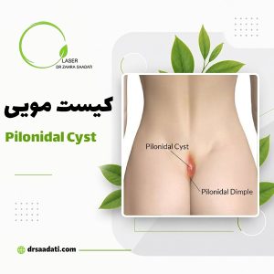 کیست مویی پیلونیدال