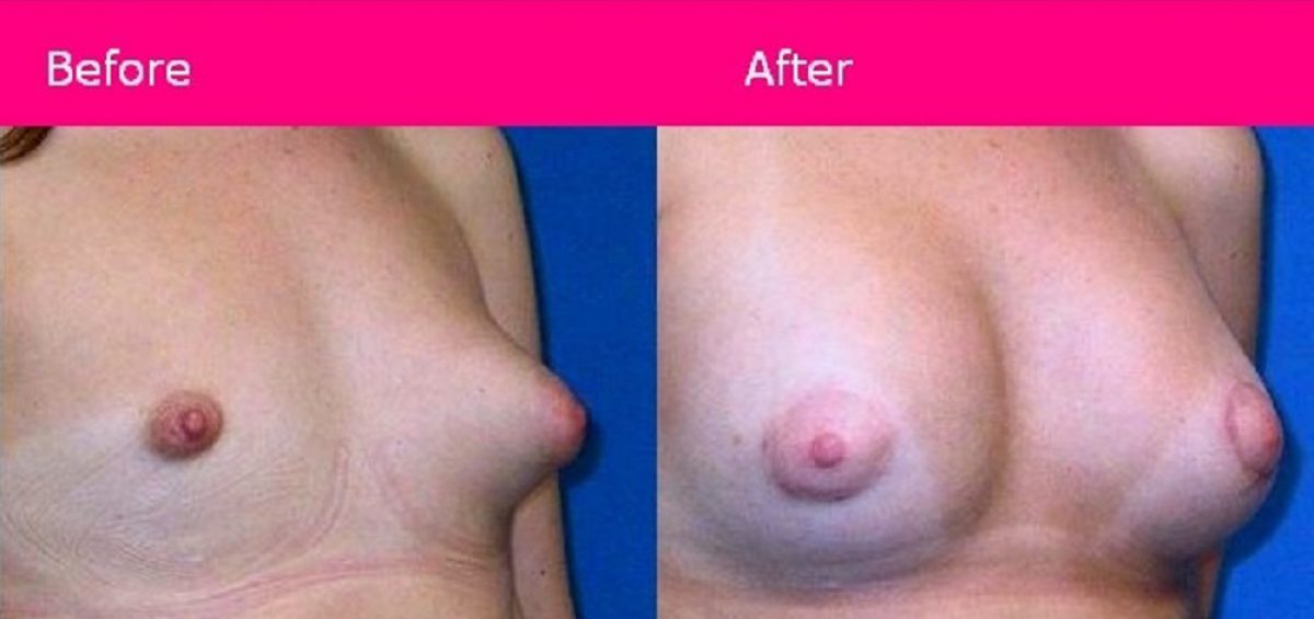 جراحی پروتز سینه به منظور قرینه سازی و افزایش سایز سینه زنان