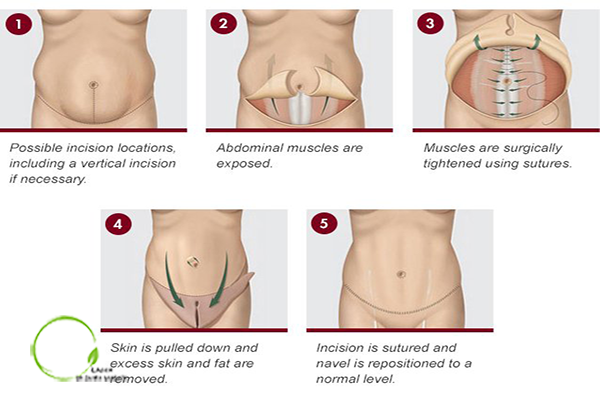 روش های ترکیبی و مرتبط با جراحی زیبایی شکم