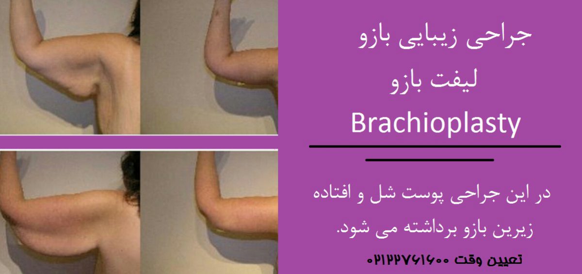 قبل و بعد جراحی زیبایی بازو جهت کوچک کردن و لیفت بازو