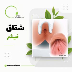 شقاق مقعدی یا فیشر-علائم، علت و راه های درمان