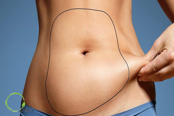 راه های کاهش کبودی پس از جراحی زیبایی شکم