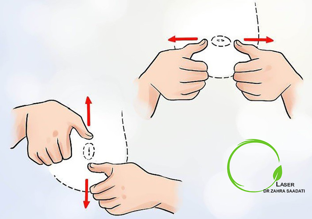 تکنیک هافمن برای درمان فرورفتگی نوک سینه