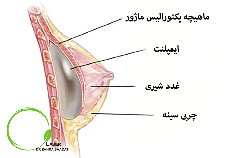 جایگذاری پروتز سینه زیر عضله