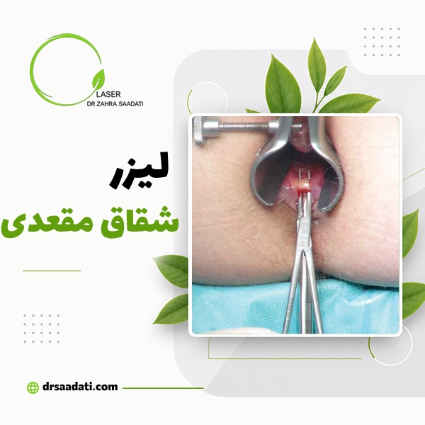 لیزر شقاق مقعدی(فیشر)؛انواع روش ها،مراحل و مزایای لیزر فیشر