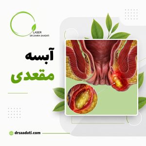 آبسه مقعدی ؛ علت و علائم آبسه مقعدی