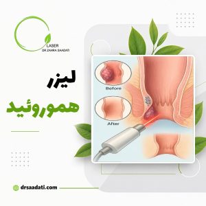 لیزر هموروئید یا بواسیر؛ انواع روش ها و مزایای درمان بواسیر با لیزر