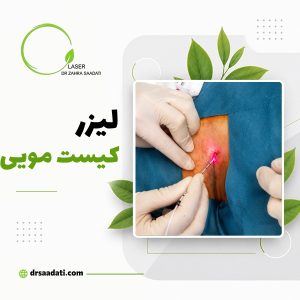لیزر کیست مویی پیلونیدال؛ درمان کیست مویی با لیزر بدون بیهوشی در کمتر از 20دقیقه